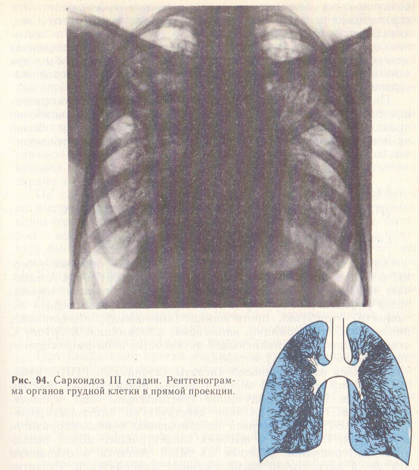 Дифференциальная диагностика туберкулеза внутригрудных лимфатических узлов