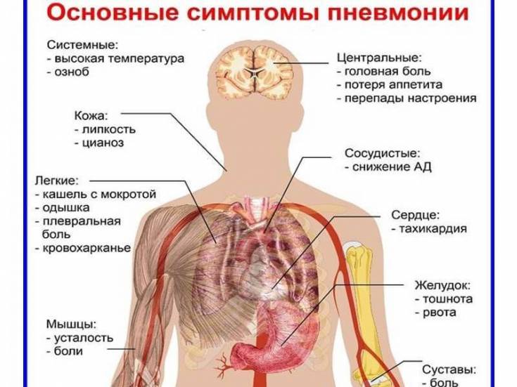 Скрытая пневмония: симптомы и лечение болезни