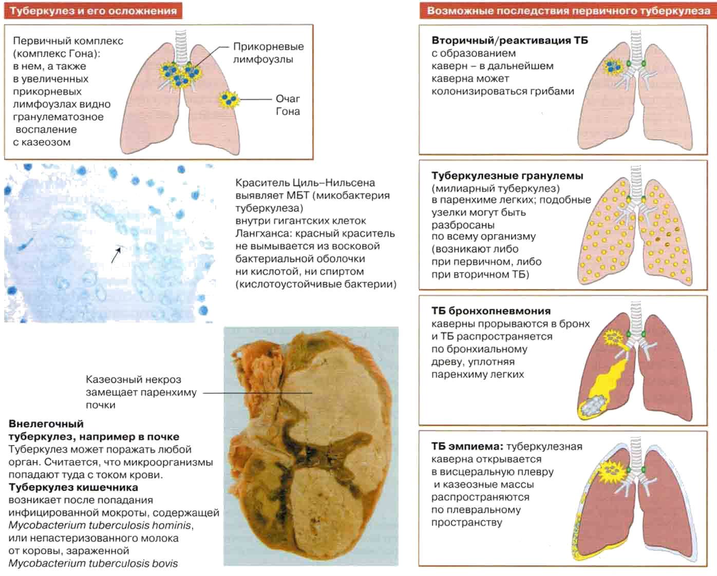 Посттуберкулезные изменения, осложнения и последствия перенесенного туберкулеза — стоптубик