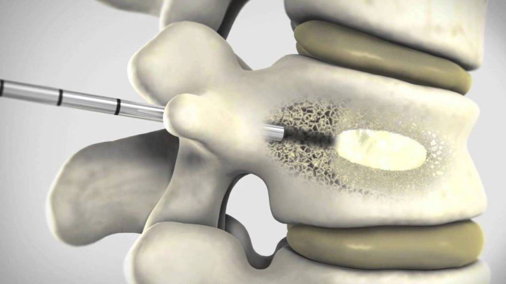 Вертебропластика позвоночника (костным цементом): после операции