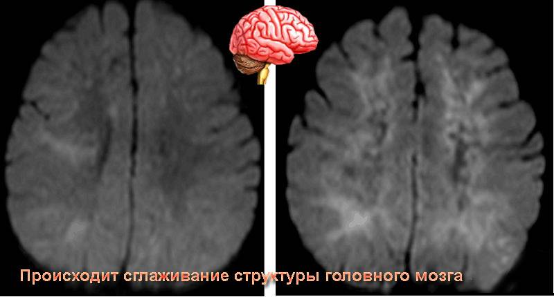 Резидуальная энцефалопатия головного мозга у детей - что это такое: код мкб 10