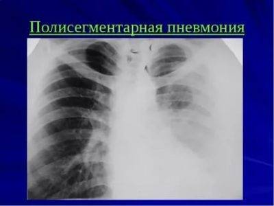 Полисегментарная пневмония: что это такое, симптомы, лечение, прогноз