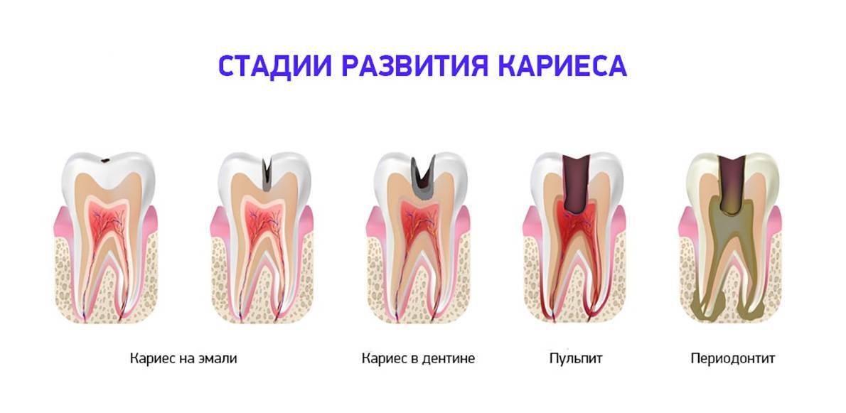 Как лечить пришеечный кариес на передних и жевательных зубах и больно ли это?