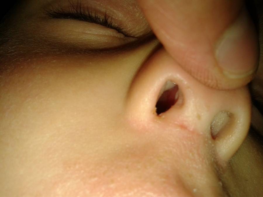 Полипы в носу у ребенка: как выглядят