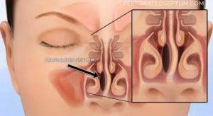 Хроническое заболевание полости носа характеризующееся атрофией слизистой
