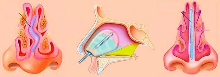 Септопластика - хирургическое лечение искривления носовой перегородки
