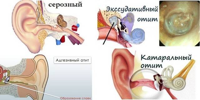 Как лечить заложенность ушей после антибиотиков. что делать, если после гриппа заложило ухо