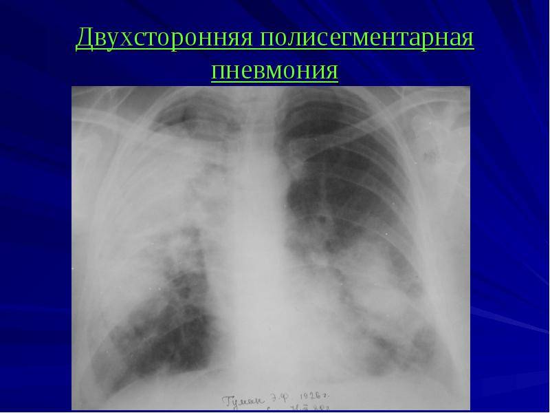 Полисегментарная пневмония: причины, симптомы, лечение
