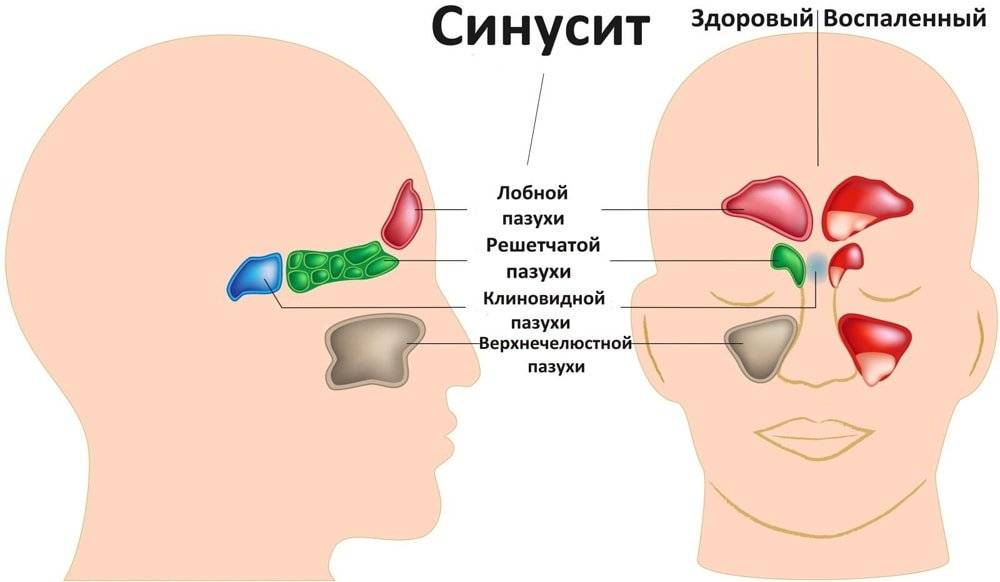 Синусит у взрослых - симптомы и лечение воспаления носовых пазух
