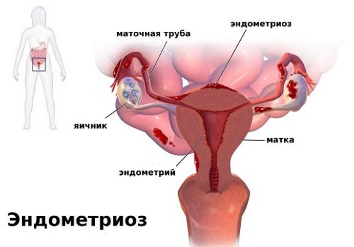 ᐉ лечение эндометриоза в период менопаузы народными средствами - sp-medic.ru