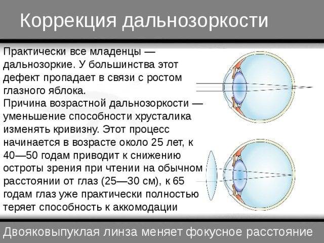 Дальнозоркость у детей: что это такое, слабой степени обоих глаз у ребенка 1 и 3 лет, детская гиперметропия, комаровский