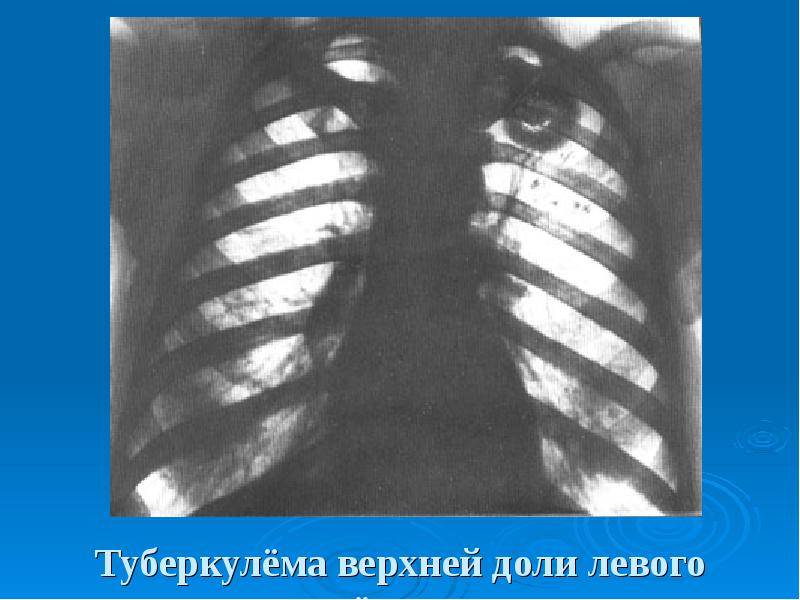 Очаговая форма туберкулеза легких