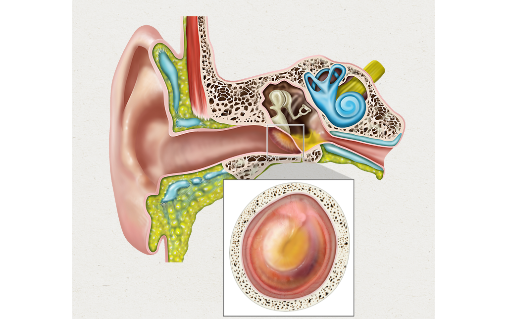 Острый наружный отит: лечение, симптомы у взрослых и детей, диффузный, в домашних условиях народными средствами уха