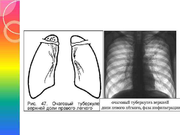 Выявление инфильтративного туберкулеза верхней доли правого легкого: симптомы, лечение, прогноз