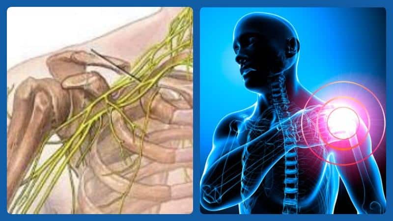 Неврит плечевого нерва: чем может быть вызван, как проявляется, терапевтические методы