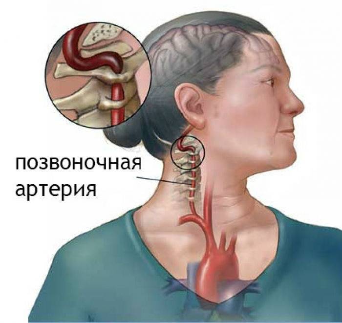 Аномалия киммерле шейного отдела позвоночника: лечение, симптомы