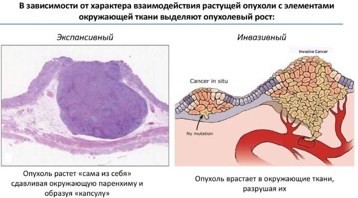 Опухоль, определение, ее отличие от других патологических процессов. классификация опухолей. система tnm.