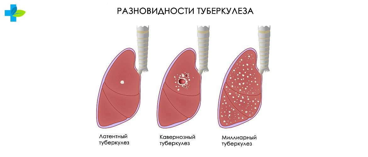 Туберкулез легких: причины, симптомы и лечение у взрослых