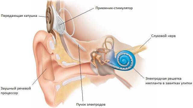 Кондуктивная и нейросенсорная потеря слуха. код по мкб-10 h90