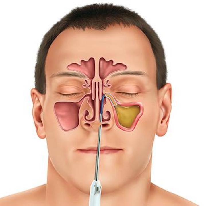 Насморк в одной ноздре - ринит и синусит у взрослого, затяжная болезнь носа не проходит, как не допустить гноя