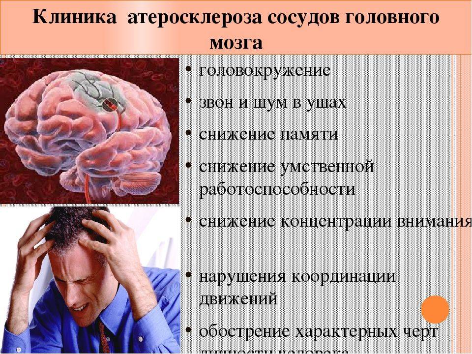 Лечение атеросклероза сосудов головного мозга: симптомы и признаки