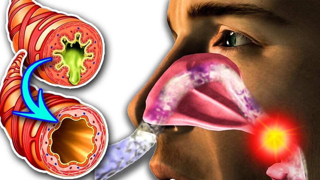 Хронический насморк - как вылечить у взрослого, лечение заложенности носа, как и чем лечить, как избавиться от ринита, народные средства