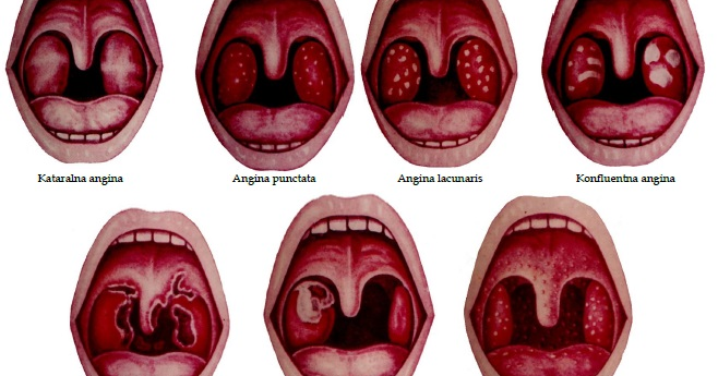Разновидности ангины: особенности симптоматики и лечения