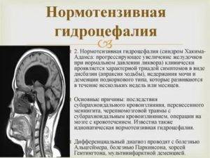 Характерные признаки наружной гидроцефалии головного мозга