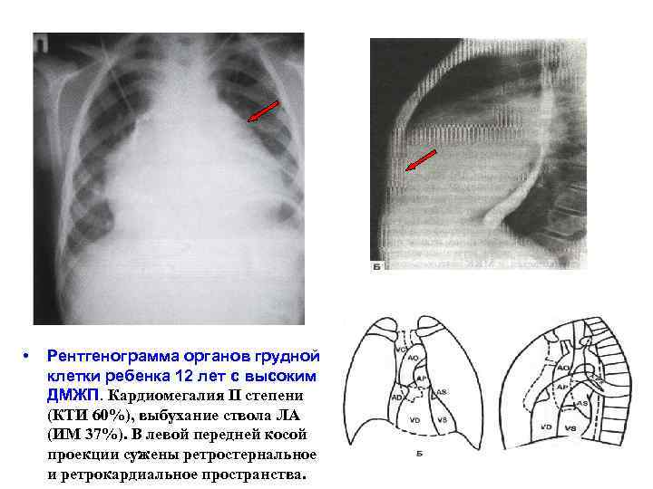 Большое сердце (кардиомегалия): что это такое, симптомы и лечение