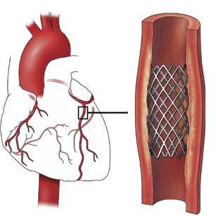 Операция стенирования сосудов сердца и ее последствия