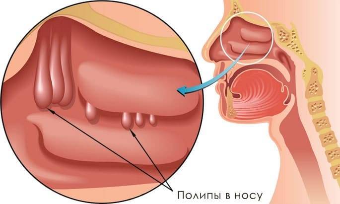 Методы лечения полипов в носу: операция и народные средства | компетентно о здоровье на ilive