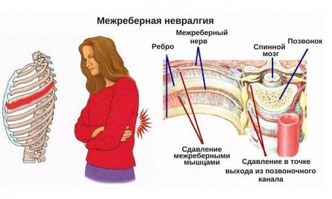 Межреберная невралгия справау женщин: симптомы и лечение. признаки межреберной невралгии с правой стороны под ребрами и лопаткой