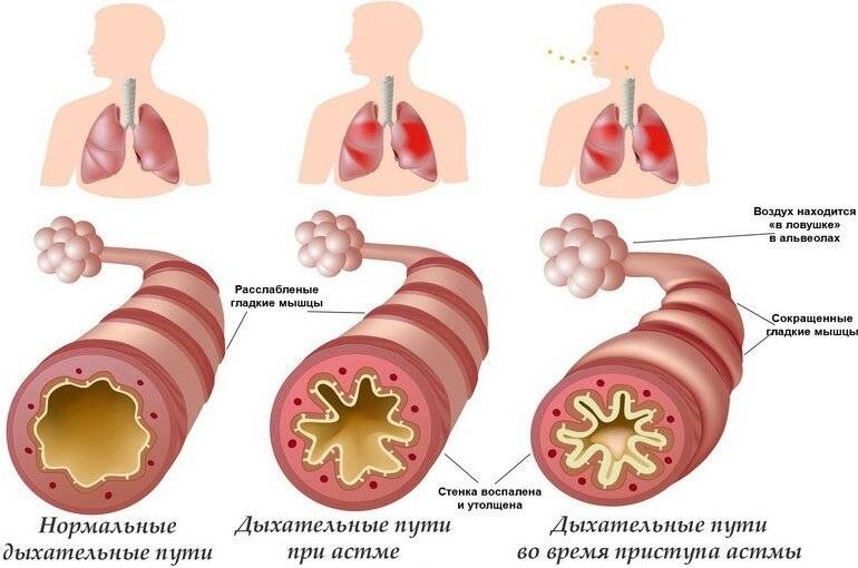 Признаки кашлевой формы бронхиальной астмы