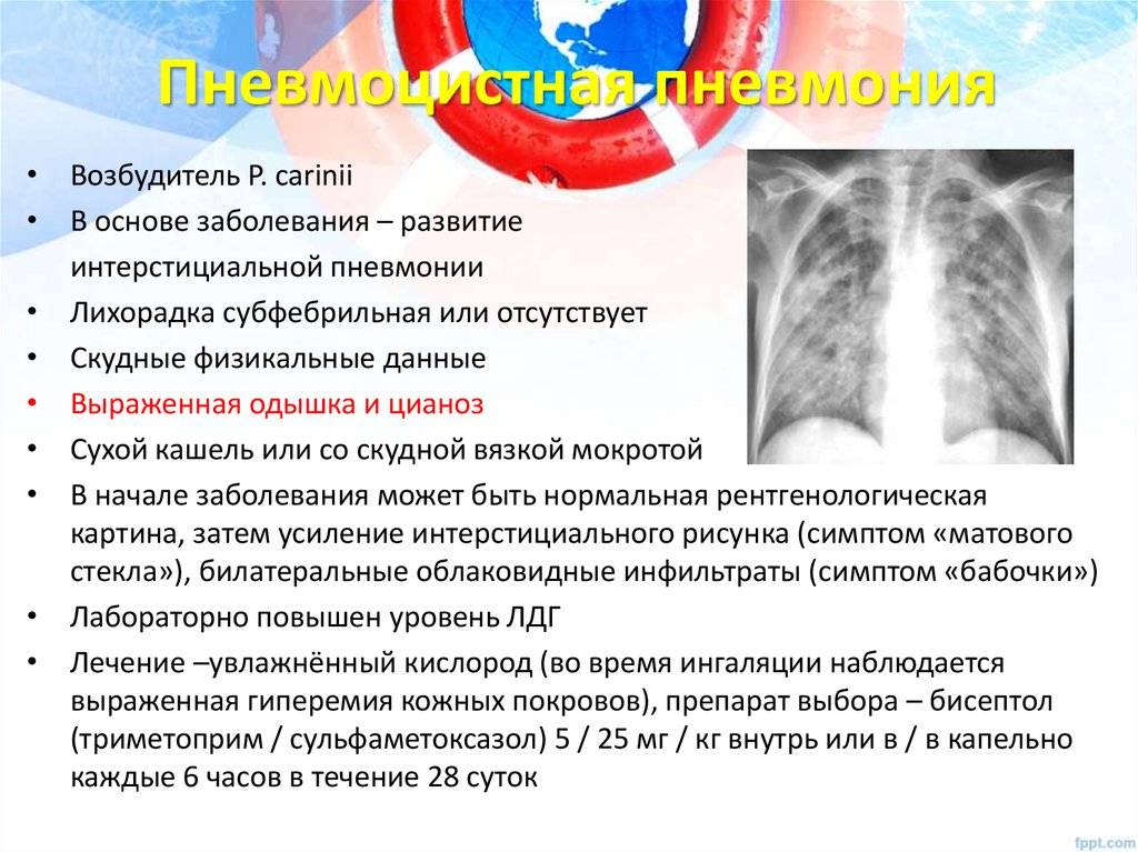 Пневмоцистная пневмония: что это такое, симптомы у вич-инфицированных и расшифровка кода мкб-10, лечение в последней стадии вич и морфология болезни | fok-zdorovie.ru