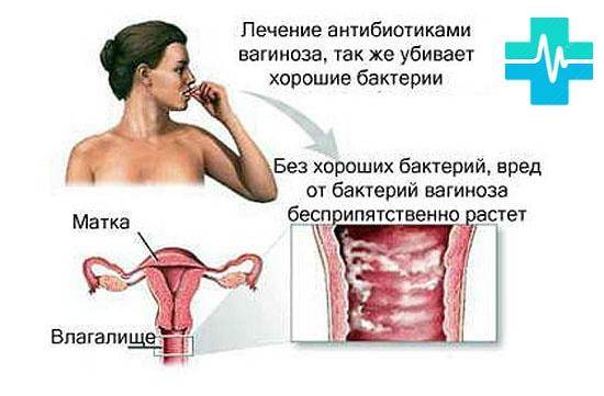 Гарднереллез при беременности: можно ли забеременеть при гарднереллезе