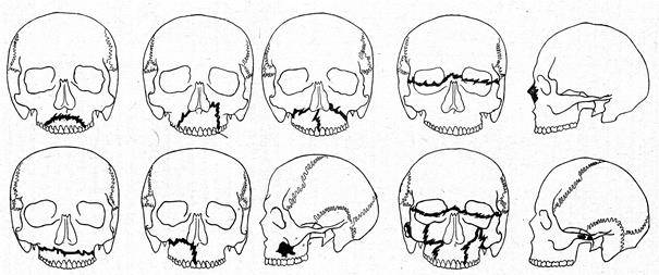 Перелом верхней челюсти: как проходит лечение