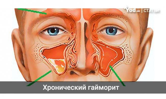 Осложнения и последствия гайморита - что ждёт, если не лечить болезнь pulmono.ru
осложнения и последствия гайморита - что ждёт, если не лечить болезнь