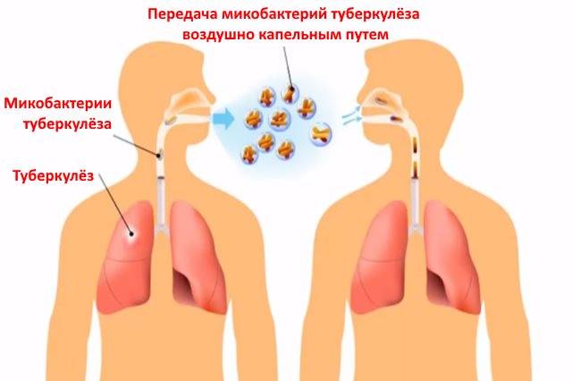Пневмония – как передается и симптомы проявления