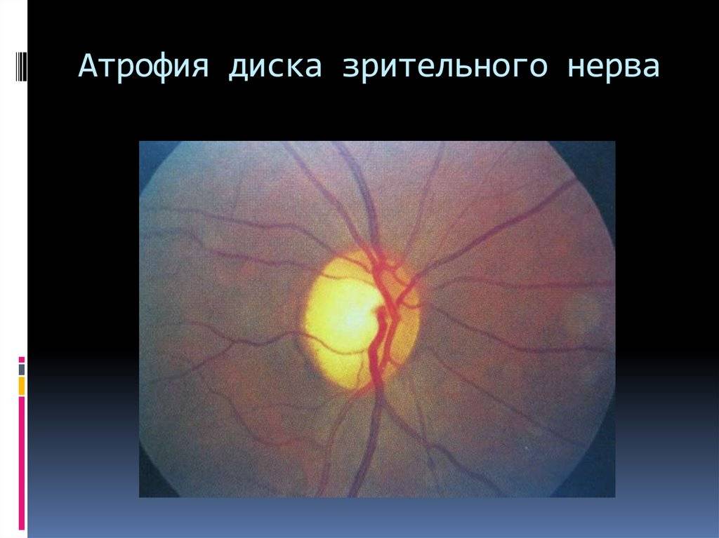 Что такое атрофия зрительного нерва и насколько данная патология опасна?