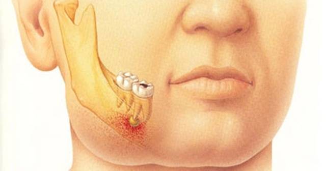 Гнилостно-некротическая флегмона дна полости рта, или ангина людвига | книги по стоматологии