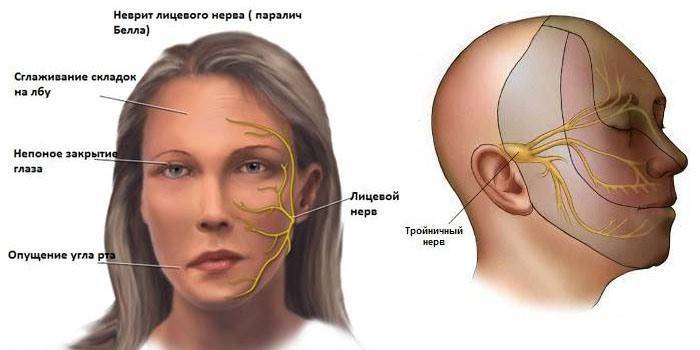 Как быстро вылечить невралгию (воспаление) лицевого нерва