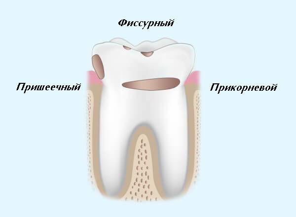 Лечение глубокого кариеса: этапы, как лечат лечебной прокладкой при диагностике в клинике, пломбирование в стоматологии