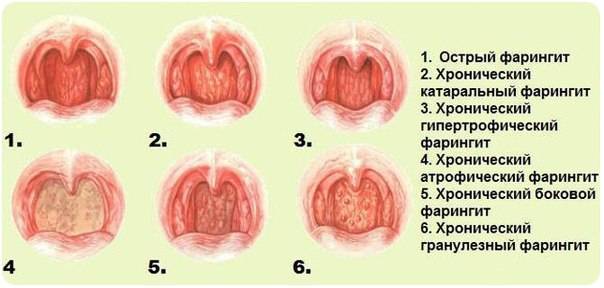 Гранулезный фарингит: фото горла, симптомы и лечение острого и хронического гранулезного фарингита