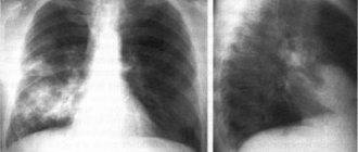 Пневмония при раке легких: особенности диагностики и лечения