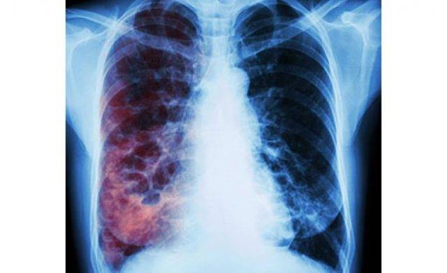 Туберкулез легких - первые симптомы, описание признаков ранней стадии заболевания у взрослых и детей, лечение