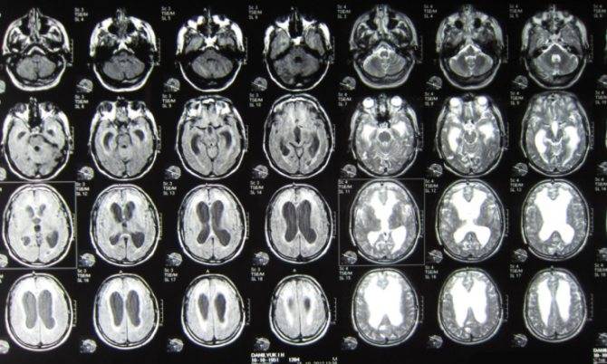 Гидроцефалия головного мозга у взрослого: симптомы, диагностика, лечение