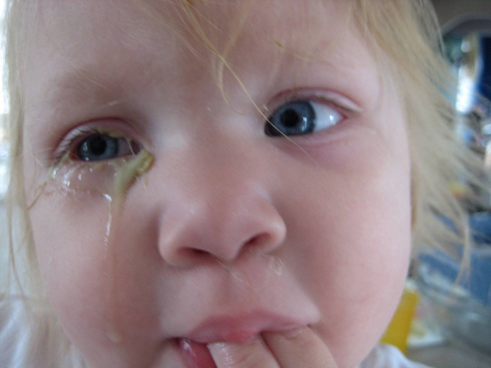 Почему у ребенка слезятся глаза и текут сопли