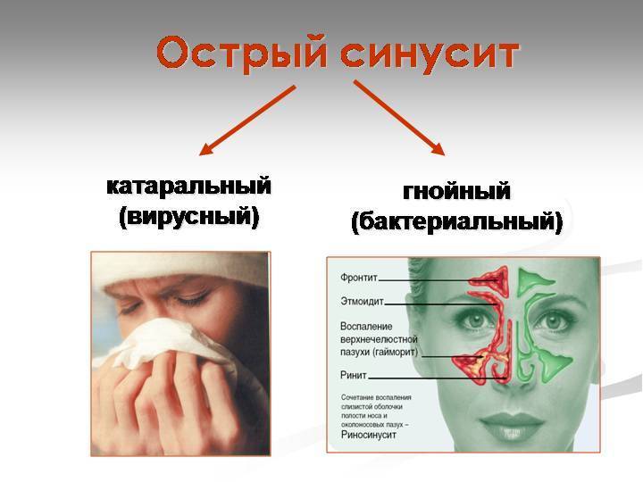 Хронический и острый риносинусит: симптомы и лечение у взрослых и детей - medside.ru