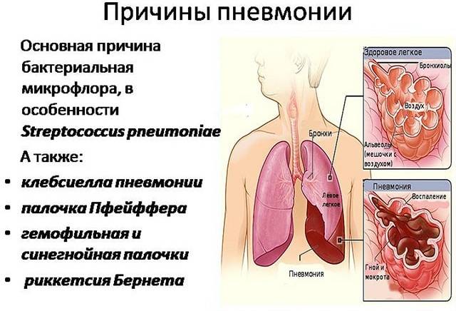Чем опасна пневмония у взрослых