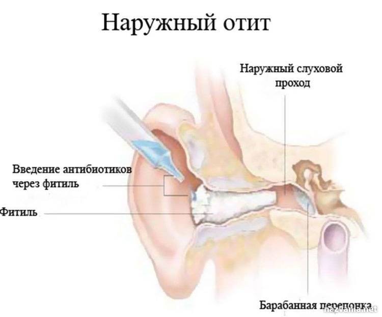 Наружный диффузный отит: симптомы и лечение pulmono.ru
наружный диффузный отит: симптомы и лечение